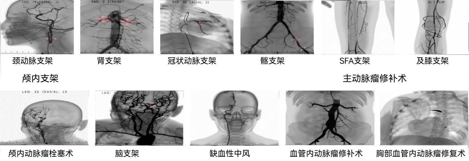 球囊血管成形術和(hé / huò)支架置入
